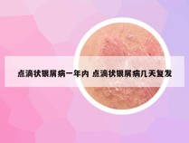 点滴状银屑病一年内 点滴状银屑病几天复发