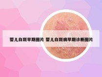 婴儿白斑早期图片 婴儿白斑病早期诊断图片