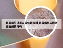 银屑病可以用二硫化硒洗剂 银屑病用二硫化硒洗剂管用吗