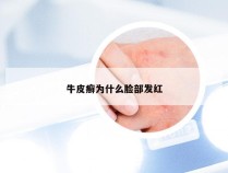 牛皮癣为什么脸部发红