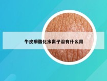 牛皮癣酸化水离子浴有什么用