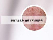 癣破了怎么办 癣破了可以用药吗