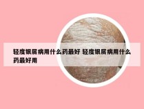 轻度银屑病用什么药最好 轻度银屑病用什么药最好用