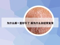 为什么癣一直好不了 癣为什么会经常复发