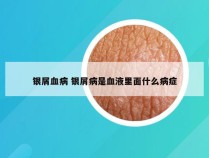 银屑血病 银屑病是血液里面什么病症