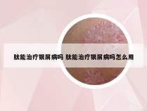 肽能治疗银屑病吗 肽能治疗银屑病吗怎么用