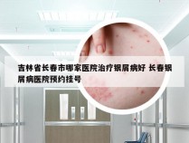 吉林省长春市哪家医院治疗银屑病好 长春银屑病医院预约挂号