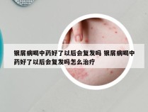 银屑病喝中药好了以后会复发吗 银屑病喝中药好了以后会复发吗怎么治疗