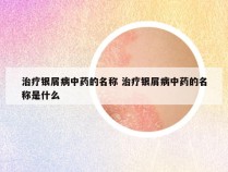 治疗银屑病中药的名称 治疗银屑病中药的名称是什么