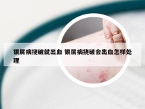 银屑病挠破就出血 银屑病挠破会出血怎样处理