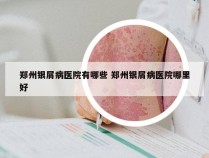 郑州银屑病医院有哪些 郑州银屑病医院哪里好