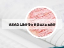 银屑病怎么治好得快 银屑病怎么治最好