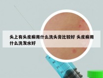 头上有头皮癣用什么洗头膏比较好 头皮癣用什么洗发水好