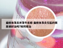 扁桃体发炎并发牛皮癣 扁桃体发炎引起的银屑病好治吗?如何根治