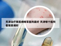 天津治疗银屑病哪家医院最好 天津哪个医院看银屑病好