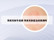 铁皮石斛牛皮癣 铁皮石斛能治皮肤病吗