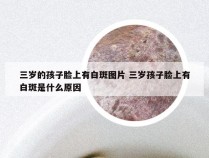 三岁的孩子脸上有白斑图片 三岁孩子脸上有白斑是什么原因