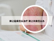 脚上起癣怎么治疗 脚上长癣怎么办