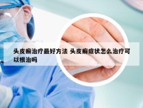 头皮癣治疗最好方法 头皮癣症状怎么治疗可以根治吗