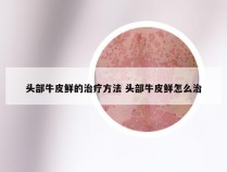 头部牛皮鲜的治疗方法 头部牛皮鲜怎么治