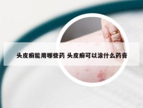 头皮癣能用哪些药 头皮癣可以涂什么药膏