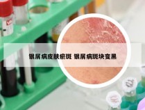 银屑病皮肤瘀斑 银屑病斑块变黑