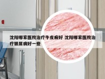 沈阳哪家医院治疗牛皮癣好 沈阳哪家医院治疗银屑病好一些