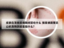 皮肤在发银屑病期间禁吃什么 银屑病需要忌口的发物到底是指什么?