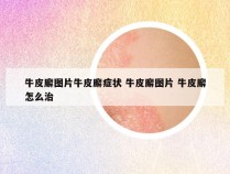 牛皮廨图片牛皮廨症状 牛皮廨图片 牛皮廨怎么治