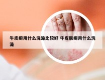 牛皮癣用什么洗澡比较好 牛皮肤癣用什么洗澡