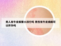 男人有牛皮癣要小孩行吗 男性有牛皮病癣可以怀孕吗