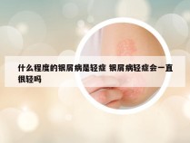 什么程度的银屑病是轻症 银屑病轻症会一直很轻吗