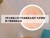 9岁小孩身上长了牛皮癣怎么治疗 九岁男孩得了银屑病怎么办