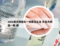 zz01像大拇指头一块癣怎么治 长在大拇指一侧 癣