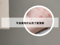 牛皮癣为什么热了就发痒