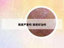 银屑严重吗 银屑好治吗