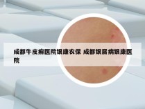 成都牛皮癣医院银康农保 成都银屑病银康医院