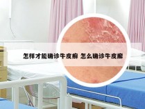 怎样才能确诊牛皮癣 怎么确诊牛皮廨