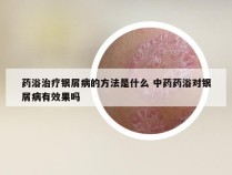 药浴治疗银屑病的方法是什么 中药药浴对银屑病有效果吗