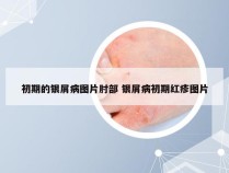 初期的银屑病图片肘部 银屑病初期红疹图片