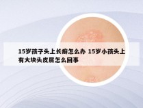 15岁孩子头上长癣怎么办 15岁小孩头上有大块头皮屑怎么回事