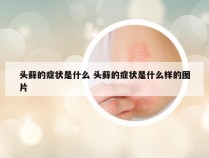 头藓的症状是什么 头藓的症状是什么样的图片