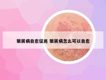 银屑病自愈征兆 银屑病怎么可以自愈