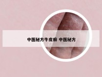 中医秘方牛皮癣 中医秘方