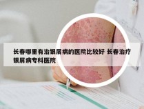 长春哪里有治银屑病的医院比较好 长春治疗银屑病专科医院