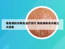 银屑病的诊断及治疗技巧 银屑病具有诊断三大现象