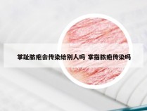 掌趾脓疱会传染给别人吗 掌指脓疱传染吗