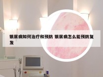 银屑病如何治疗和预防 银屑病怎么能预防复发