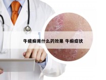 牛疲癣用什么药效果 牛癣症状