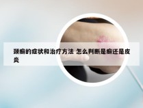 颈癣的症状和治疗方法 怎么判断是癣还是皮炎